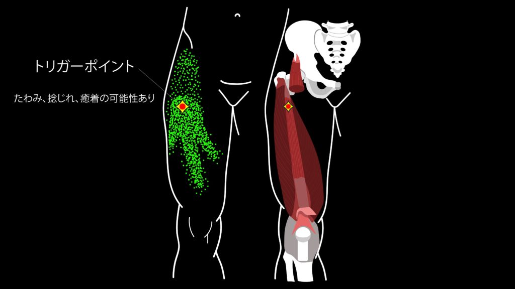 トリガーポイントの画像